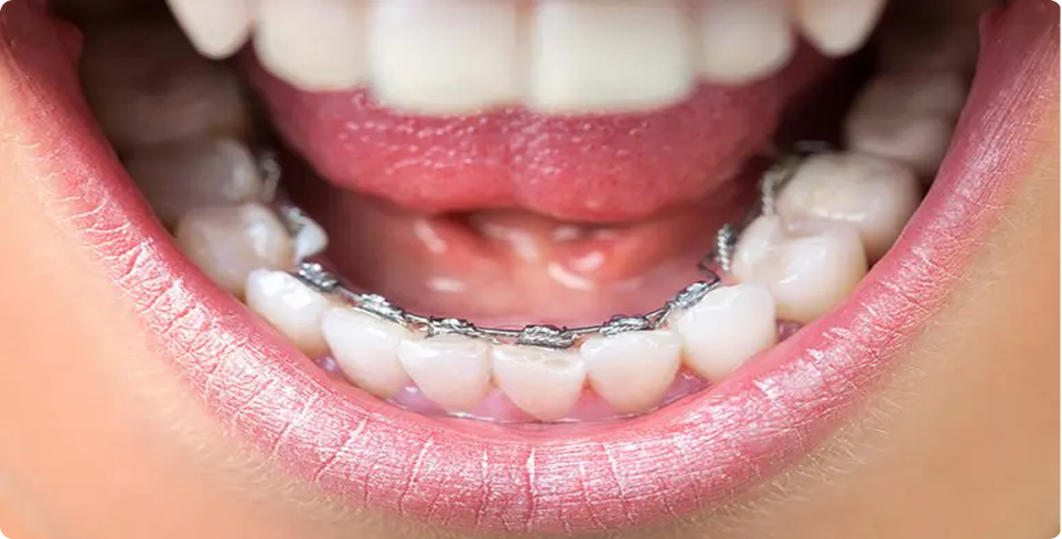Lingual Braces